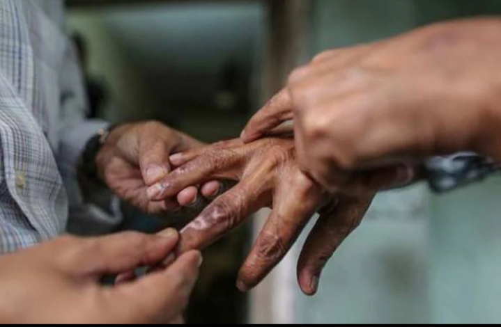 प्रदेश २ र सुदूरपश्चिम प्रदेशमा अत्यधिक कुष्ठरोगी, हरेक वर्ष बढ्छन् ३ हजार रोगी