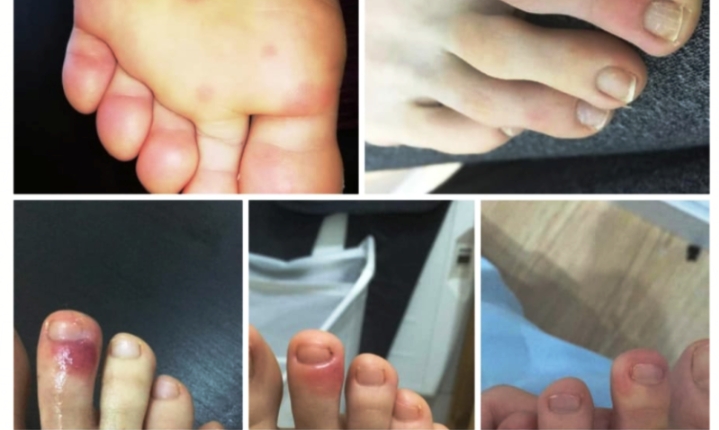 वैज्ञानिकको नयां खोज : खुट्टाको औँलामा पनि देखिन्छ कोरोना लक्षण !