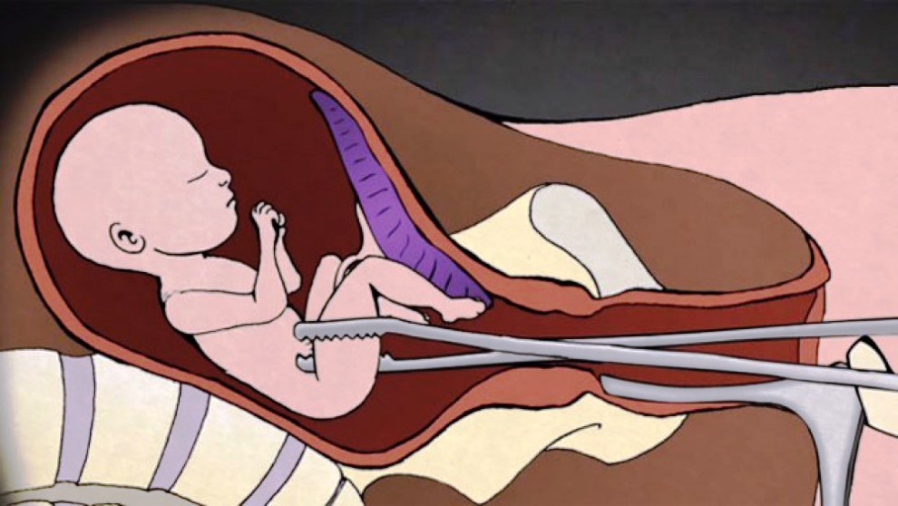 आज राष्ट्रिय सुरक्षित गर्भपतन दिवस : १३ लाख महिलाले लिइन् सेवा