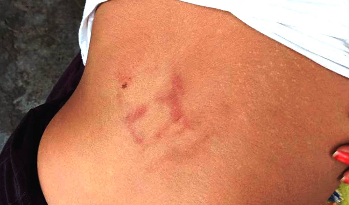 पानी छोएको भन्दै दलित बालिकामाथि निर्घात कुटपिट, प्रहरीमा पर्यो उजुरी