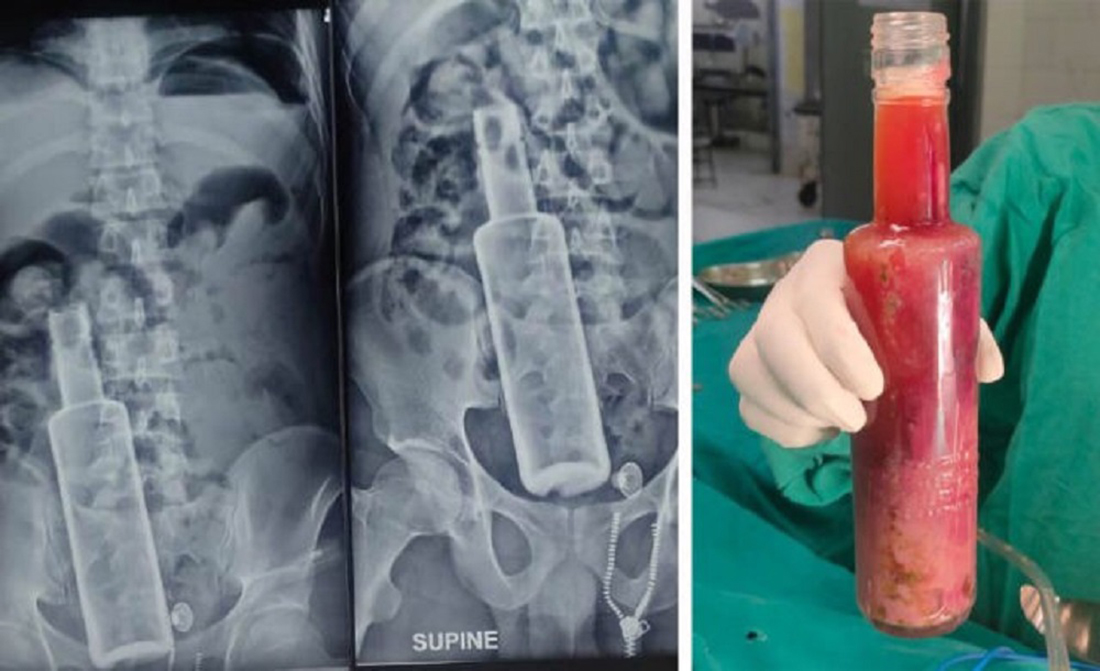 साथीकै पेटमा दारुको बोतल घुसाएका युवक जेल चलान